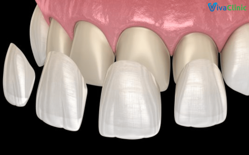 Dán sứ Veneer giúp răng trắng sáng tự nhiên mà không cần mài răng nhiều