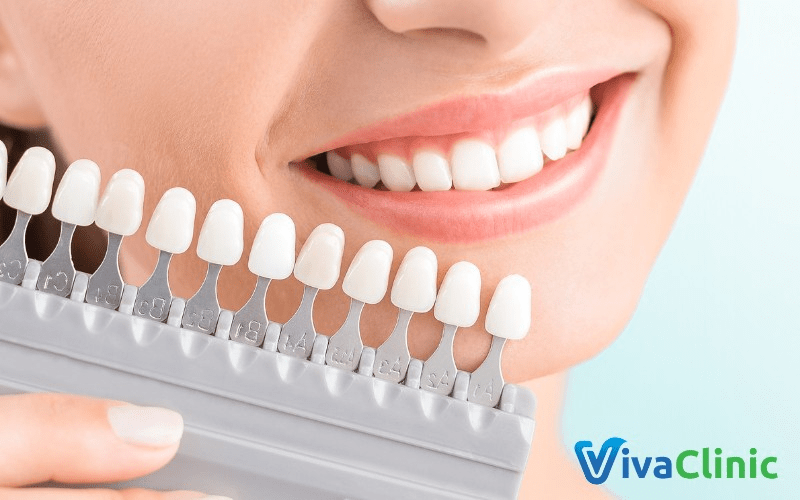 Răng sứ Veneer có tuổi thọ lên đến 15 năm