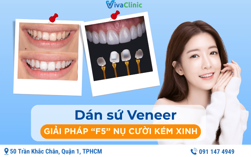 dán sứ veneer